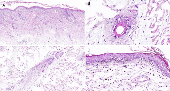 vasculitis hialinizante