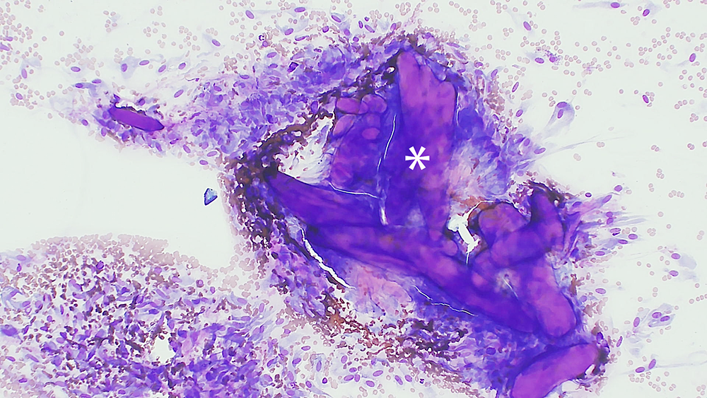 Fine needle aspirate of a subcutaneous keloidal fibroma from a 3-year-old male castrated dog.