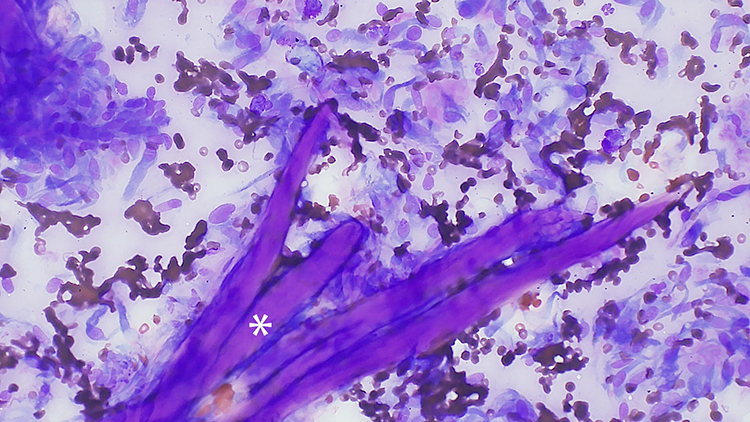 Fine needle aspirate of a subcutaneous keloidal fibroma from a 3-year-old male castrated dog. Higher magnification view.