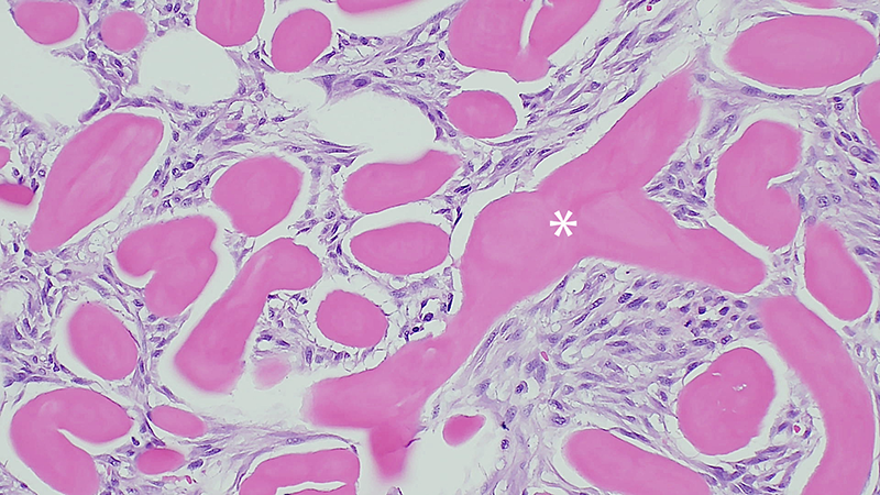 Neoplastic fibroblasts surround numerous large fibrils and bundles of hyalinized eosinophilic collagen.