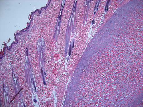 A well demarcated, unencapsulated spindle cell neoplasm elevates the dermis and epidermis.