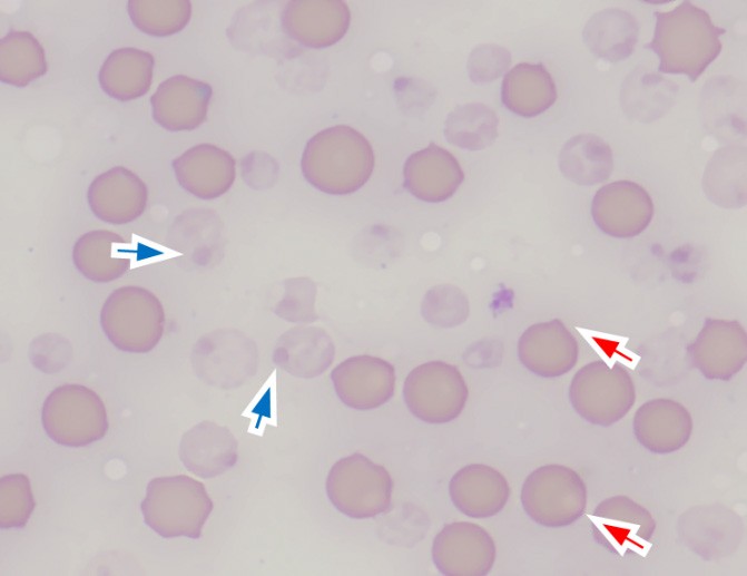 Microscopic blood smear showing numerous pink erythrocytes of varying appearance on a pale background. Two red arrows indicate intact erythrocytes containing small, dark Heinz bodies attached to the cell membrane. Two blue arrows indicate pale, translucent ghost erythrocytes with Heinz bodies, consistent with oxidative damage and hemolysis. Wright’s-Giemsa stain, 1000× magnification.
