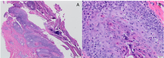 Histopathology Skin Biopsy