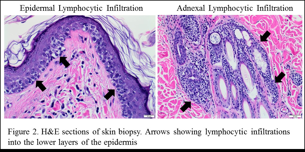 Diagnostic skin lymphoma dissertation